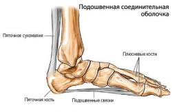 Zašto boli metatarzalna kost stopala?