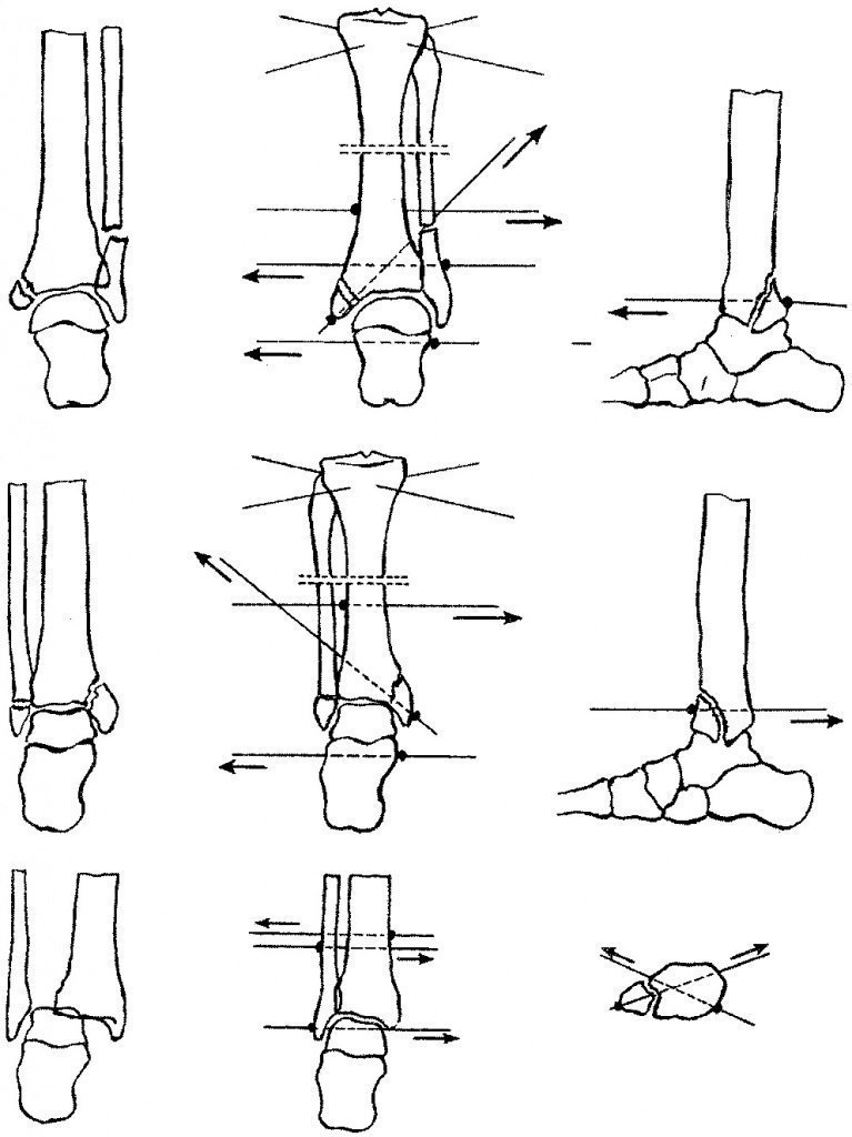 Перелом наружной лодыжки рисунок