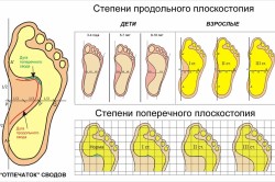 Učinkovita gimnastika za liječenje poprečnog ravnog stopala