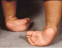 Clubfoot: symptoms, causes, diagnosis and treatment